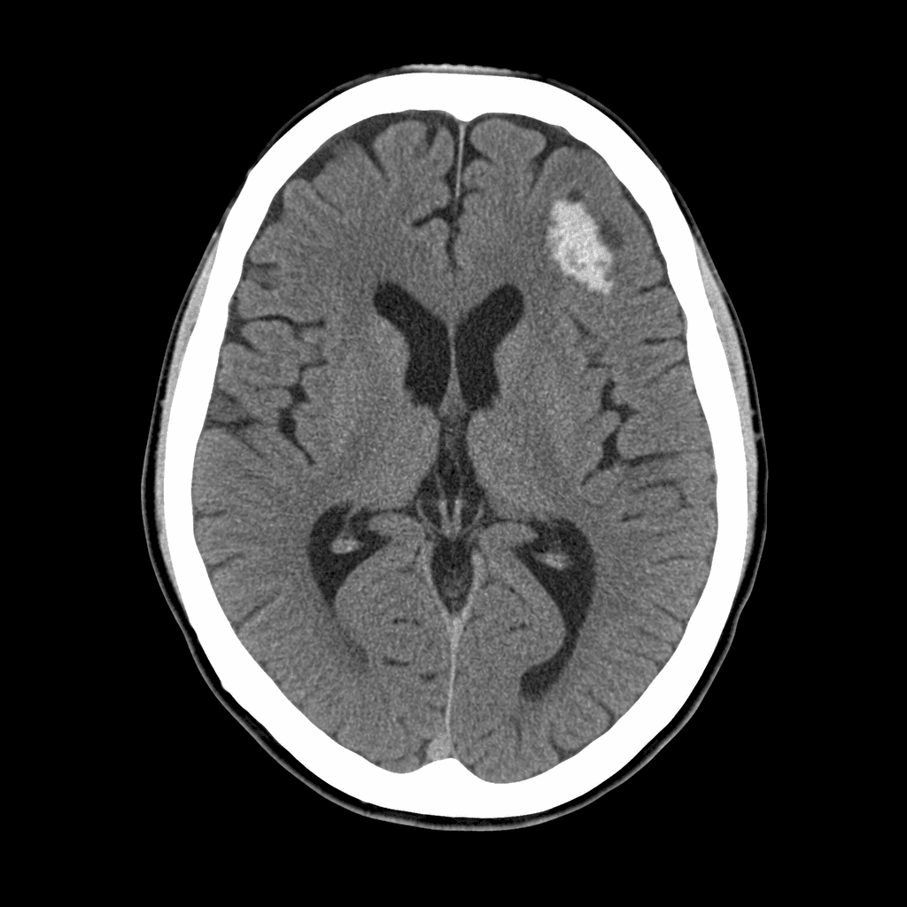 Axial head CT slice — illustrative generated imagery, not patient data